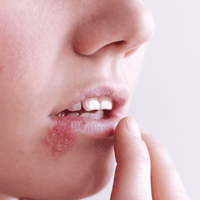 Herpes Treatment