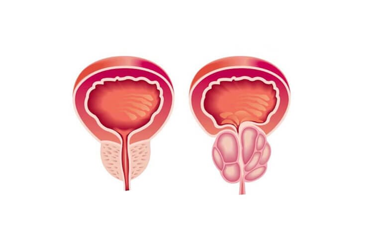 prostate-enlargement