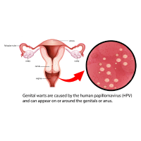 Genital Warts